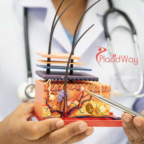 Hair Transplant (FUE) in Turkey for US Men Experiencing Hair Loss